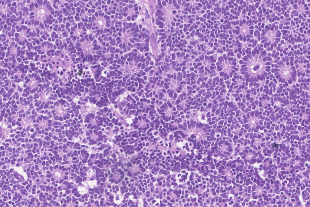 Photomicrograph shows a well differentiated retinoblastoma with Flexner - Wintersteiner and Homer - Wright rosettes.